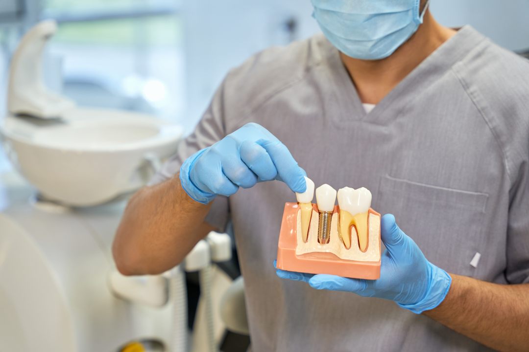 Prótesis dentales sobre implantes: pasos cruciales para el éxito