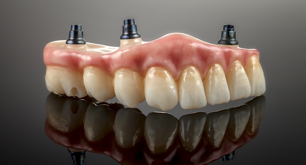 Prótesis dentales de precisión