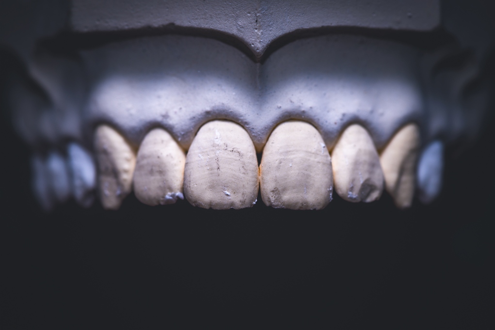 Mantenimiento de prótesis dentales: Guía completa de cuidados